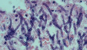 aspergillus disease